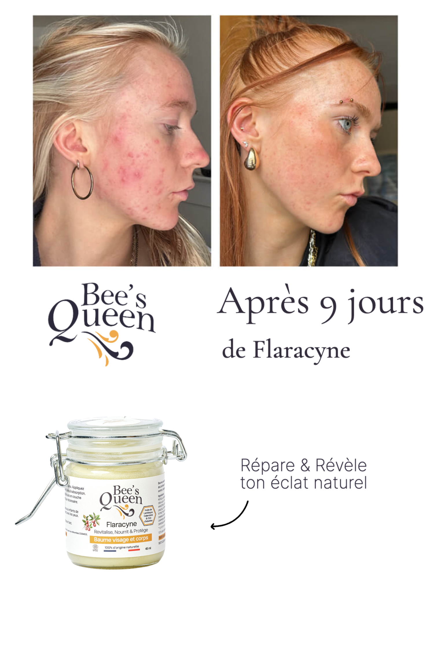 Flaracyne — apaise et répare acné, eczéma et brûlures.