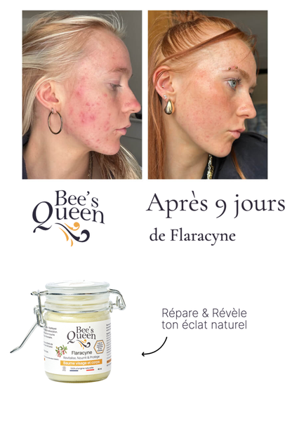 Flaracyne — apaise et répare acné, eczéma et brûlures.